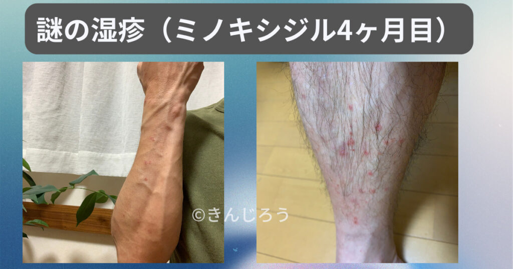 Eczema-of-unknown-origin