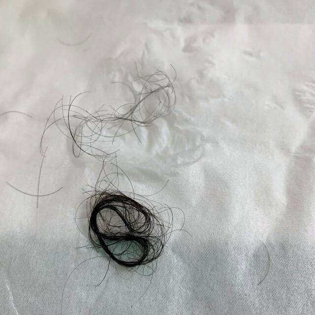 2nd-hair-loss